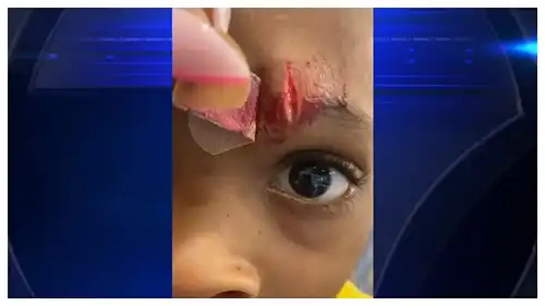 'It Could've Been His Eye': Florida School Tells Mom 5-Year-Old Son Hurt Himself with Pencil, Leaving Him with Bloody Gash, But Mother Claims Teacher Inflicted Cut with a Ruler 'It Could've Been His Eye': Florida School Tells Mom 5-Year-Old Son Hurt Himself with Pencil, Leaving Him with Bloody Gash, But Mother Claims Teacher Inflicted Cut with a Ruler